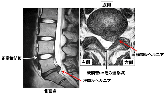 脊椎脊髄疾患について・主な疾患 | 一般社団法人 日本脊椎脊髄病学会 