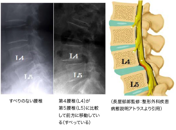 脊椎脊髄疾患について・主な疾患 | 一般社団法人 日本脊椎脊髄病学会