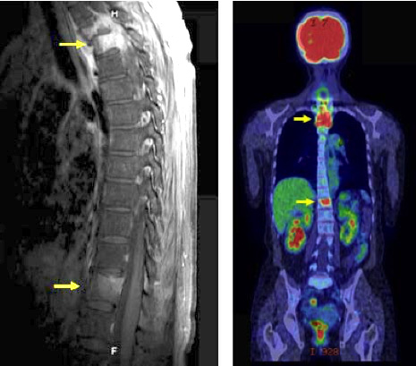 脊椎脊髄疾患について・主な疾患 | 一般社団法人 日本脊椎脊髄病学会 